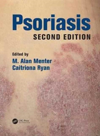 Psoriasis, Second Edition