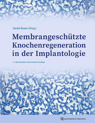 GBR-Technik in der Implantologie