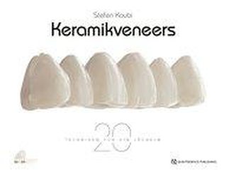 Keramikveneers