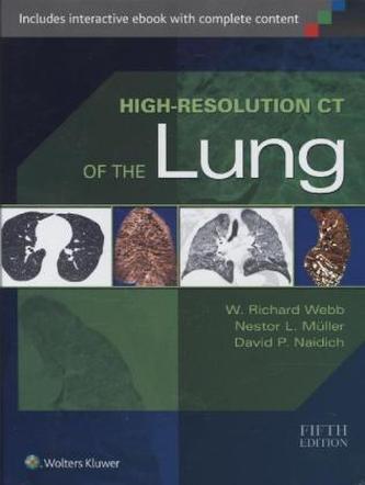High-Resolution CT of the Lung