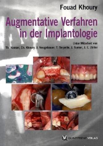 Augmentative Verfahren in der Implantologie