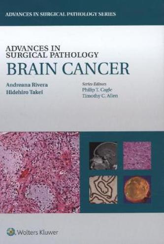 Advances in Surgical Pathology: Brain Cancer