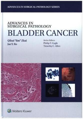 Advances in Surgical Pathology: Bladder Cancer
