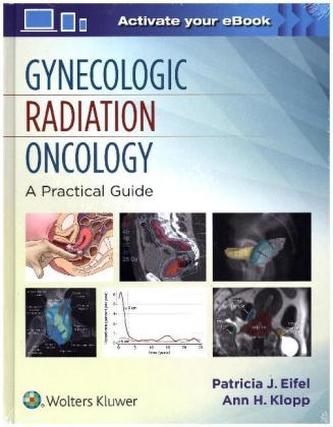 Radiotherapy for Gynecologic Cancers: A Practical Guide