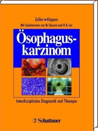 Ösophaguskarzinom