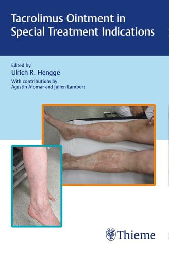 Tacrolimus Ointment in Special Treatment Indications Tacrolimus Ointment in Special Treatment Indications