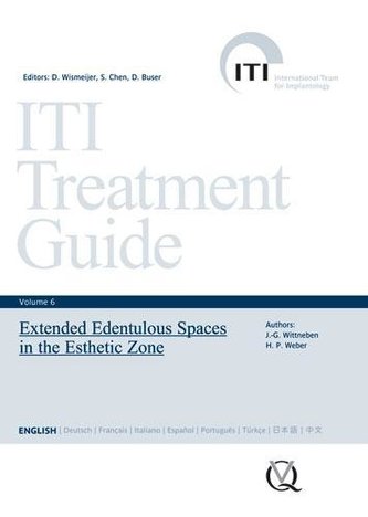 Extended Edentulous Spaces in the Esthetic Zone